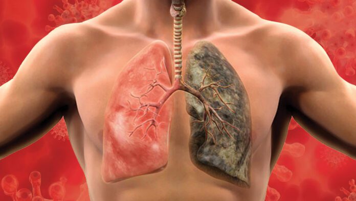 Lung Damage After Covid : কোভিডের পর ফুসফুসের ক্ষতি!!