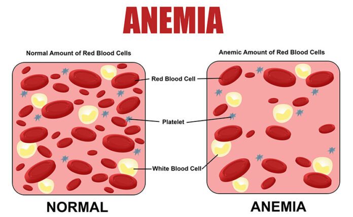 Anemia : অ্যানিমিয়ার কবলে শৈশব,শিশুদের রক্তাল্পতা বৃদ্ধি -