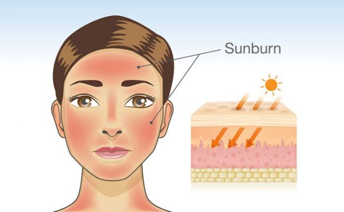 Tanned Skin : গরমের তীব্রতা, রোদে পোড়া দাগ, আর ত্বকের বিবর্ণতা!